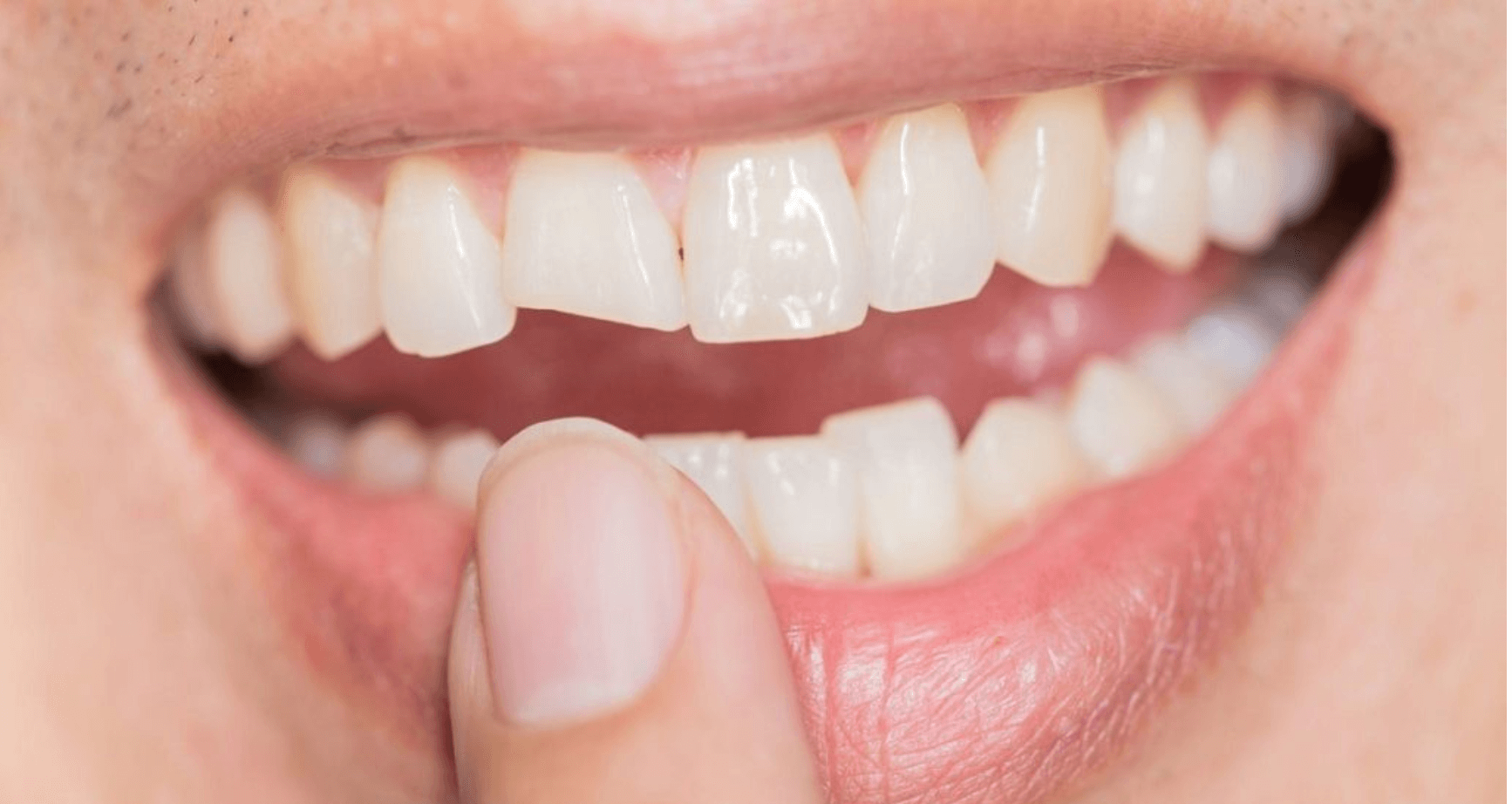traumi dentali