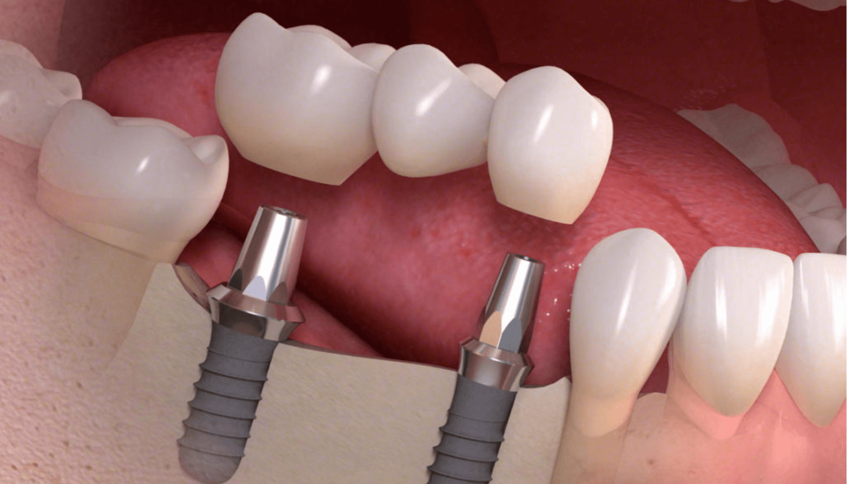 impianti dentali