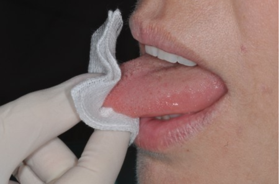 diagnosi precoce cavo orale